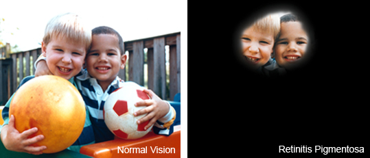 Confronto tra visione normale e visione tubolare con Retinite Pigmentosa